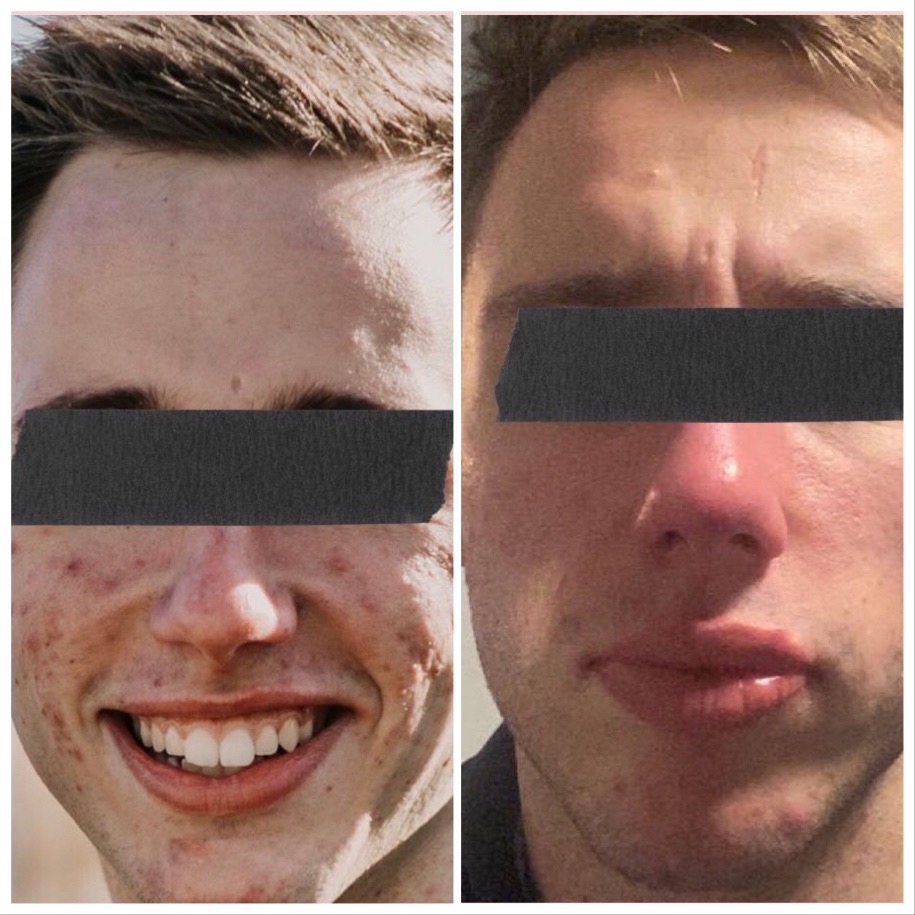 voor- en na foto Acne